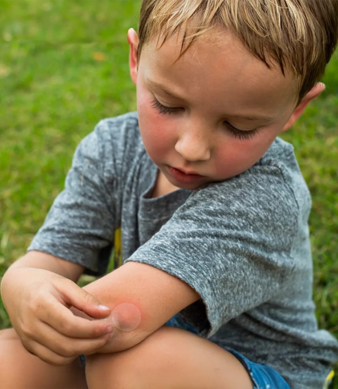 Mosquito Bites